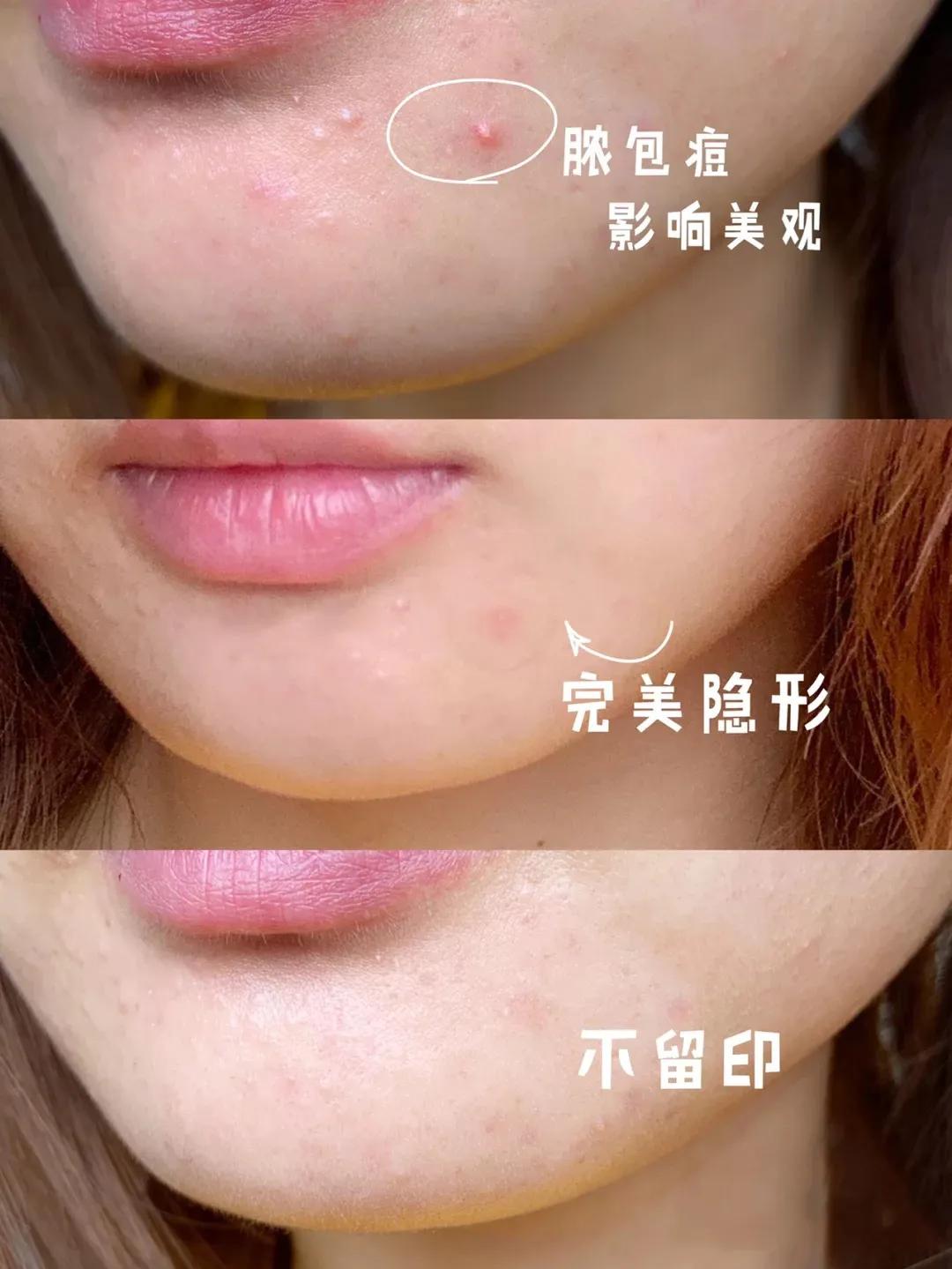 片仔癀痘痘贴解救痘痘,片仔癀祛痘印最有效的方法