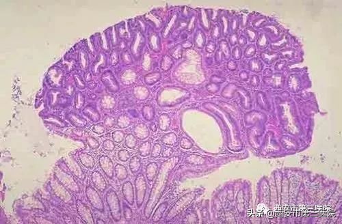 专家医生讲胆囊息肉,息肉是否越切长得越快