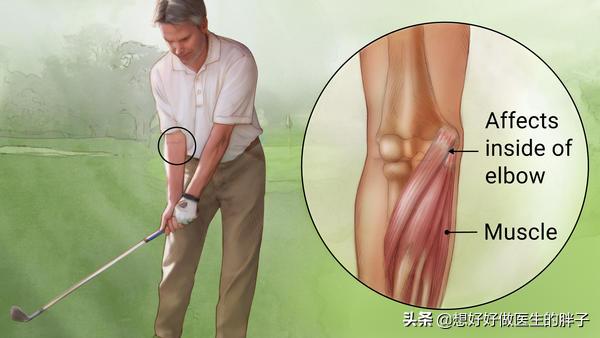 胳膊用力过度后胳膊肘疼怎么回事,胳膊肘劳累过度关节疼痛用什么药