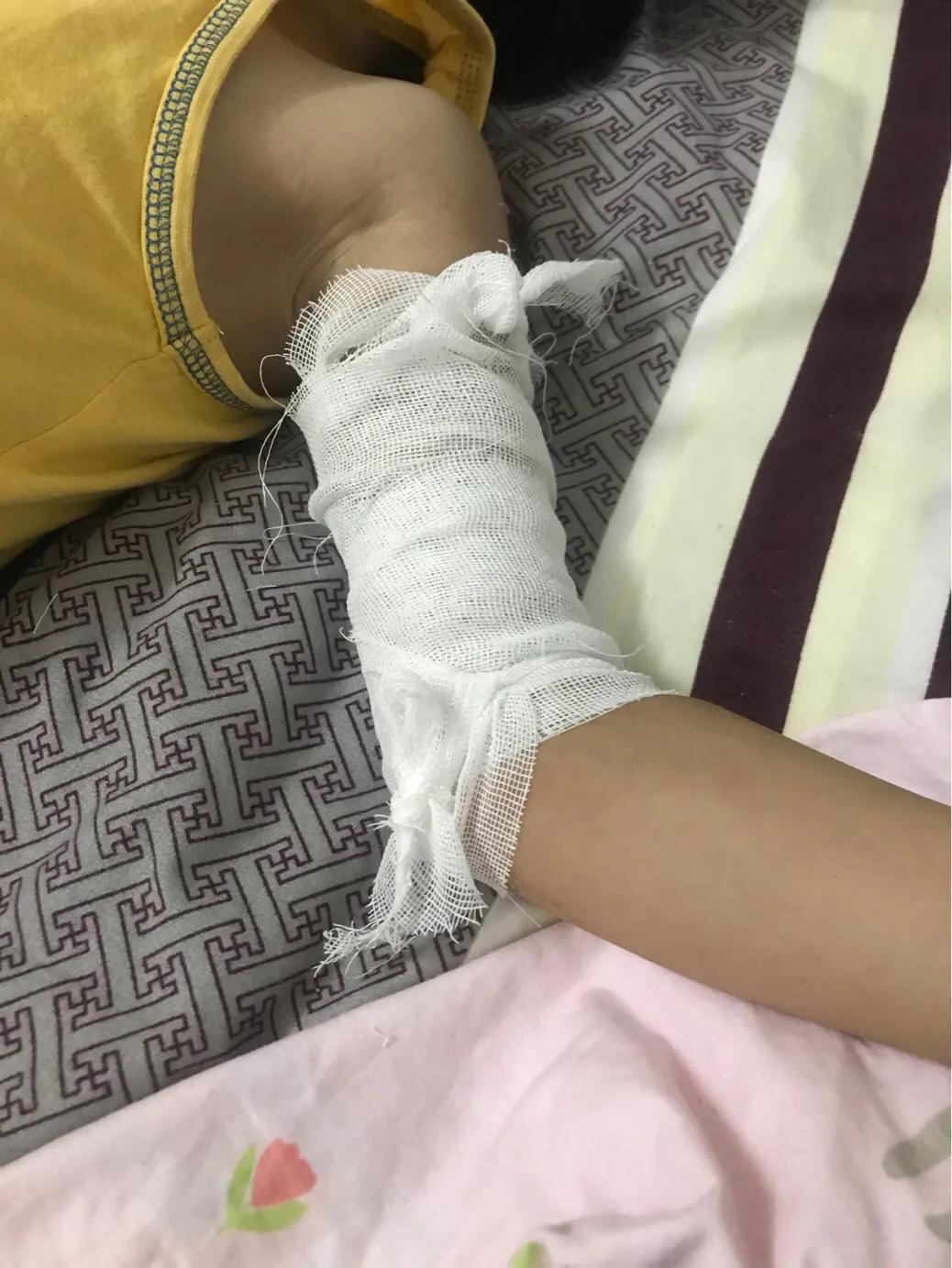 孩子大面积烫伤治疗流程,记录女儿被烫伤到治疗全过程