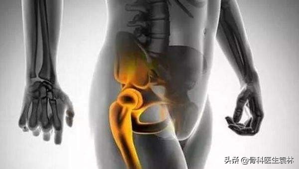 股骨头坏死的治疗方法,早期股骨头坏死如何治疗可以治愈