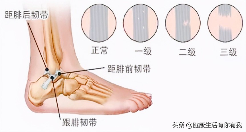 急性踝关节扭伤针灸特效穴,踝关节扭伤最新指南
