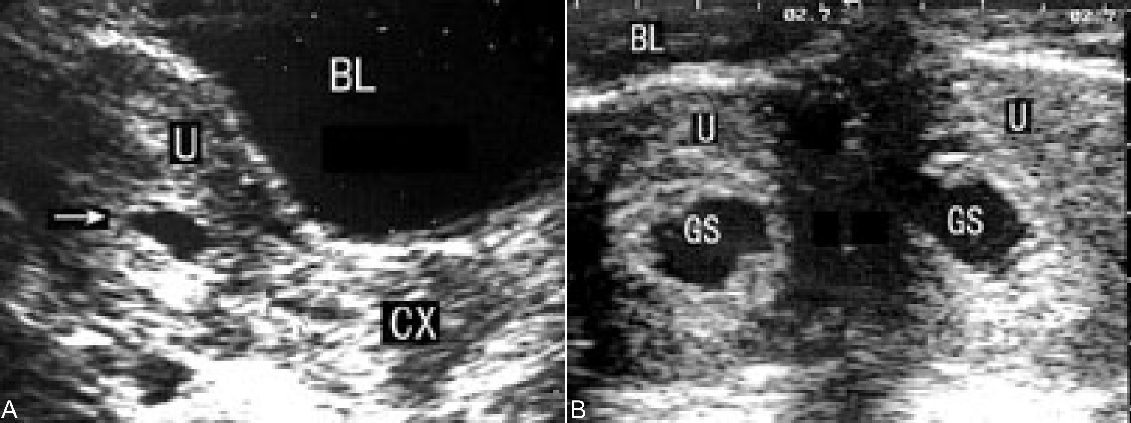 经阴超声检查可以看出来流产吗,流产残留超声诊断