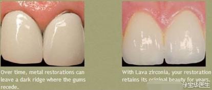 烤瓷牙贴片全口价格,贴片牙齿和烤瓷牙有哪些伤害