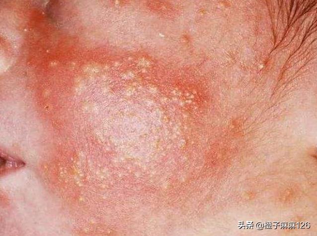 婴儿脸上起疹子跟母乳有关系吗,婴儿脸上有小疹子颗粒怎么消除