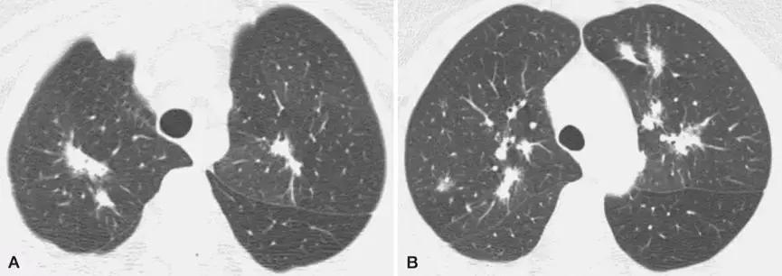 CACP2019:代华平:机化性肺炎的诊疗误区与防范