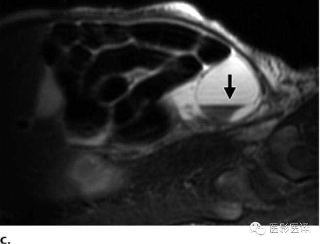 孕期发现卵巢囊肿有8cm左右,孕19周查出胎儿卵巢囊肿