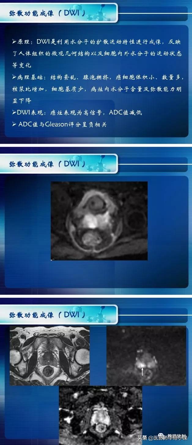 前列腺磁共振影像解剖,前列腺mri正常诊断报告模板