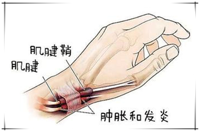 手指狭窄性腱鞘炎挂号去什么科,手指腱鞘炎按痛处吱吱响
