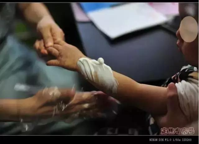 怀孕湿疹反反复复如何彻底根除,孕妇湿疹怎么治好得快