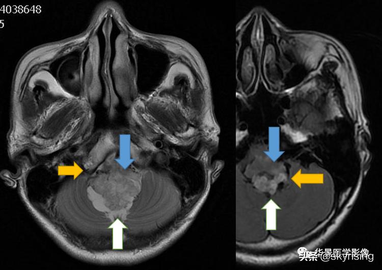 椎体侵袭性血管瘤mri影像学表现,中年妇女脑部血管海绵体瘤的症状