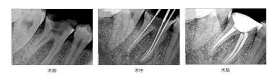 牙齿折断根部怎么弄出来,牙齿断了医生说先观察一段时间
