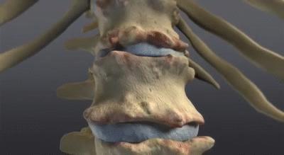 强直性脊柱炎严重的后果,儿童强直性脊柱炎早期最典型症状