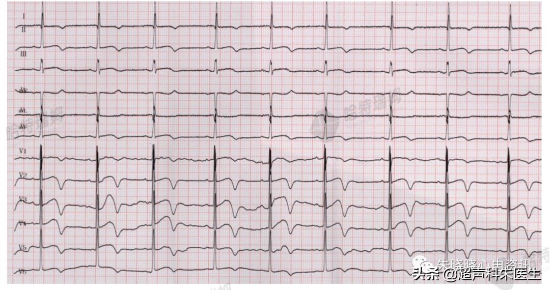 t波倒置9个真相图解,t波倒置判断口诀