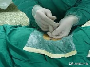 腰椎间盘突出术后复发的临床表现,极外侧型腰椎间盘突出容易复发吗