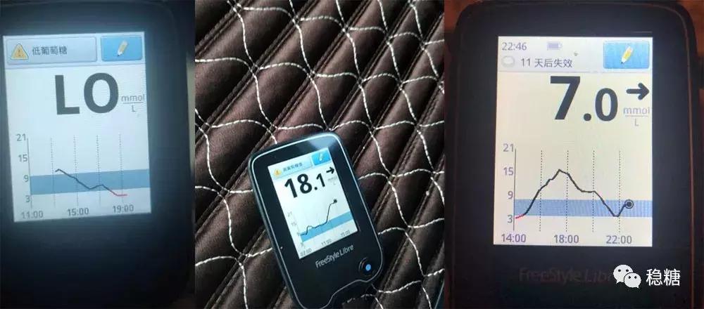 胰岛素泵闭环控糖效果,闭环胰岛素泵是什么意思