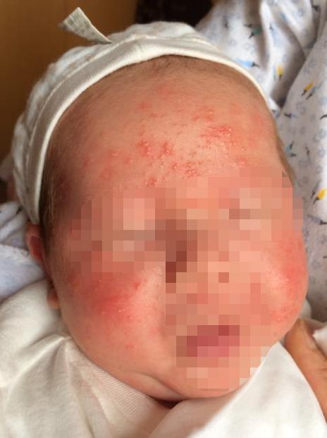 新生儿长脓疱疮需要治疗吗,新生儿宝宝常见的痘痘有哪些