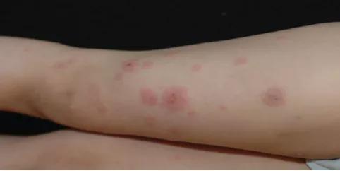 水痘和过敏疹子的区别,儿童出水痘止痒能吃过敏药吗