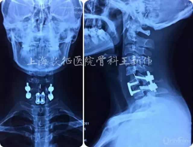 颈椎外伤受损如何治疗,颈椎损伤手术恢复怎么样
