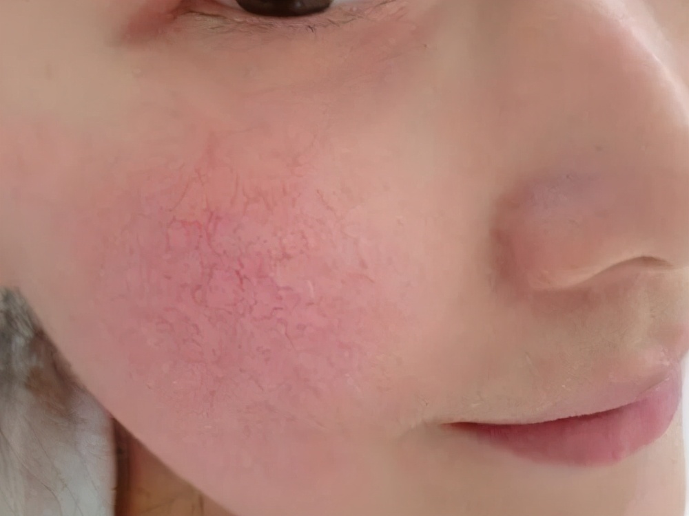脸部红血丝多怎么消除,脸部红血丝怎么消除小妙招