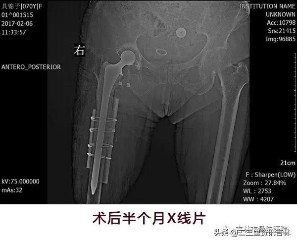 从医30余年，他治疗数以万计骨伤骨病患者