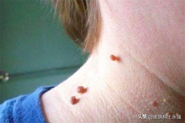 脖子上长小肉粒是已经感染hpv了吗,脖子上长丝状疣是什么病毒感染