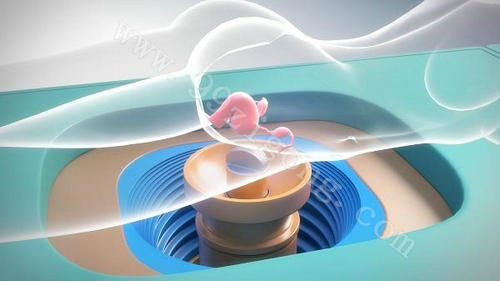 肌瘤7公分微波消融术,40分钟完美消融12公分大肌瘤