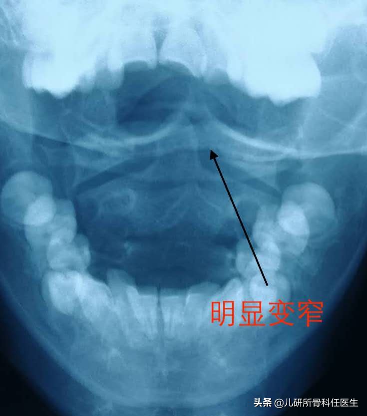 宝宝脖子突然歪了怎么办,小孩脖子落枕了头一直歪着怎么办