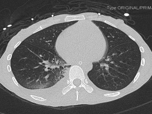 重度高碳酸血症突出表现,出现消化系统疾病的临床表现
