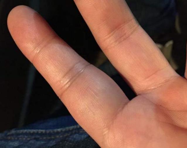 手指腱鞘炎怎么治好得快,手指有腱鞘炎怎么治才能好得快