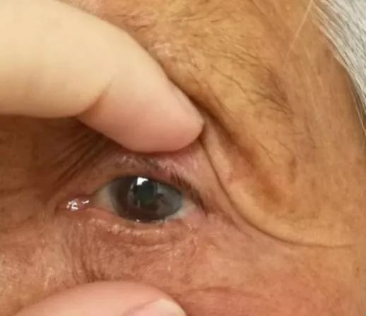 眼整形修复权威科普,科普眼整形手术是个什么手术多图