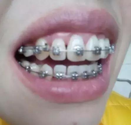 30岁龅牙矫正大概要花费多少钱,30岁龅牙还能做牙齿矫正吗