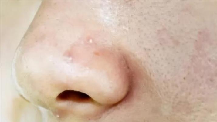 鼻子上挤出来的白色丝状物，看起来像一条虫子，是螨虫吗？