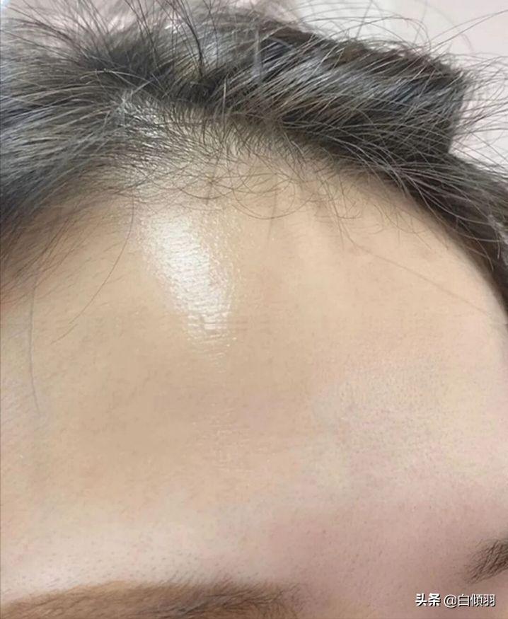 乱用水杨酸怎么办,用水杨酸软膏有危害吗