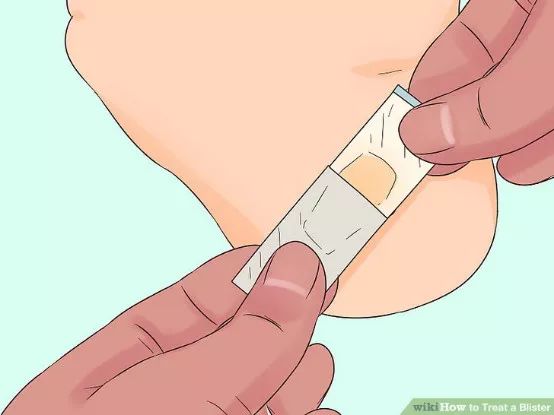 跑步脚上起水泡怎么处理好得快,脚跑步起水泡怎么处理好得快