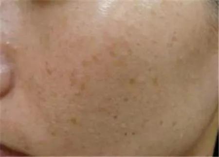 脸上的斑分为几种类型,脸上常见的6种斑