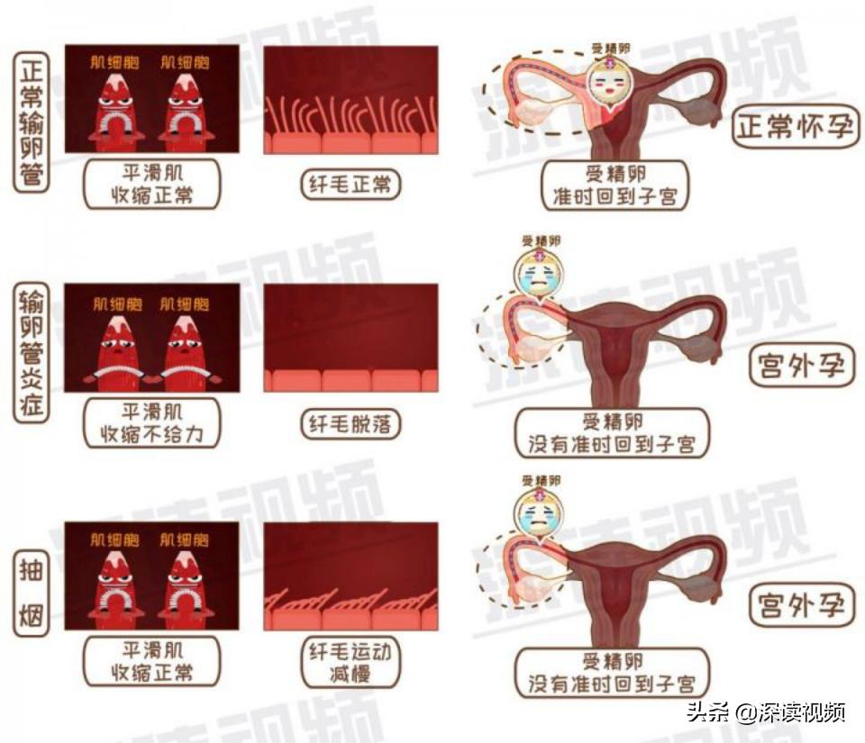 宫外孕还来大姨妈怎么回事,陈旧性宫外孕是怎么回事