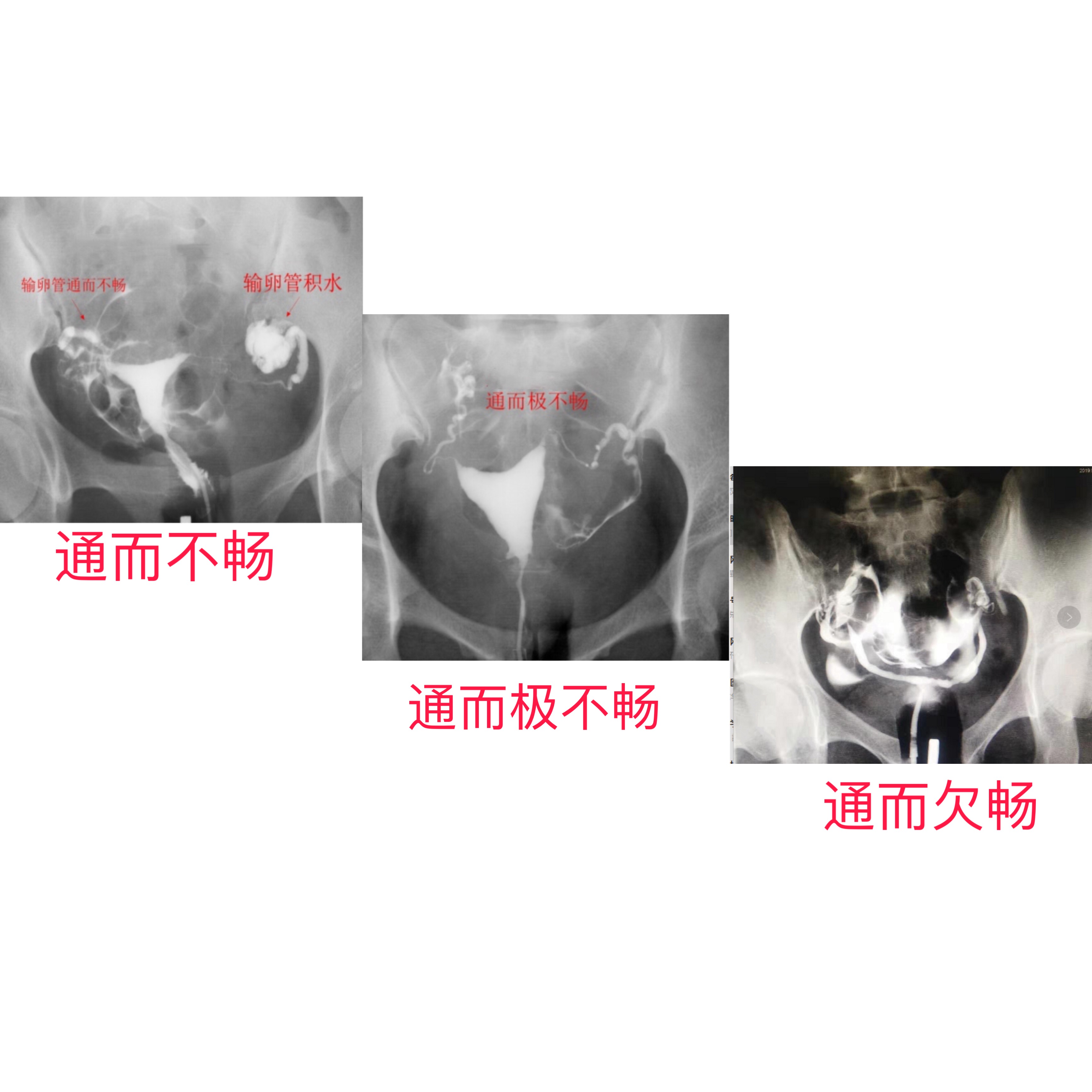 输卵管通畅度医生误诊后果严重，反复宫外孕责任在谁？