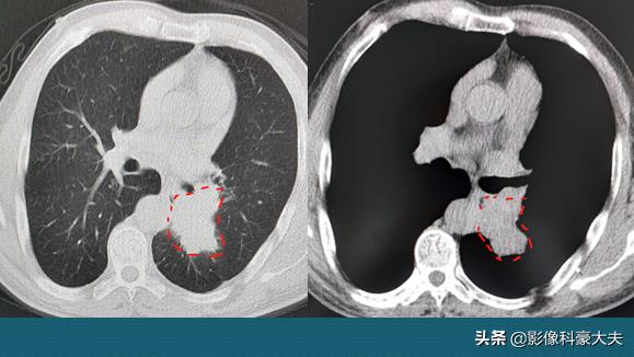 22岁查出癌症放弃治疗,医生自述得癌症放弃治疗