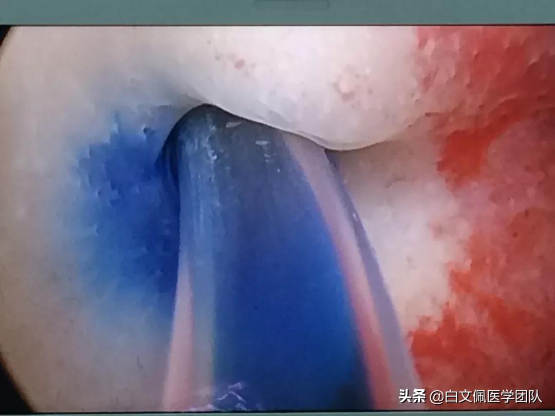 治疗输卵管近端不孕,输卵管性不孕的最佳治疗方法