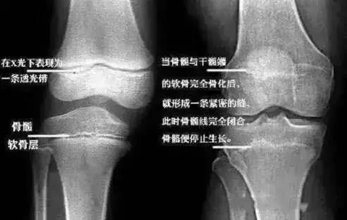 13岁孩子身高1米4,14岁小孩还在1米45怎么办