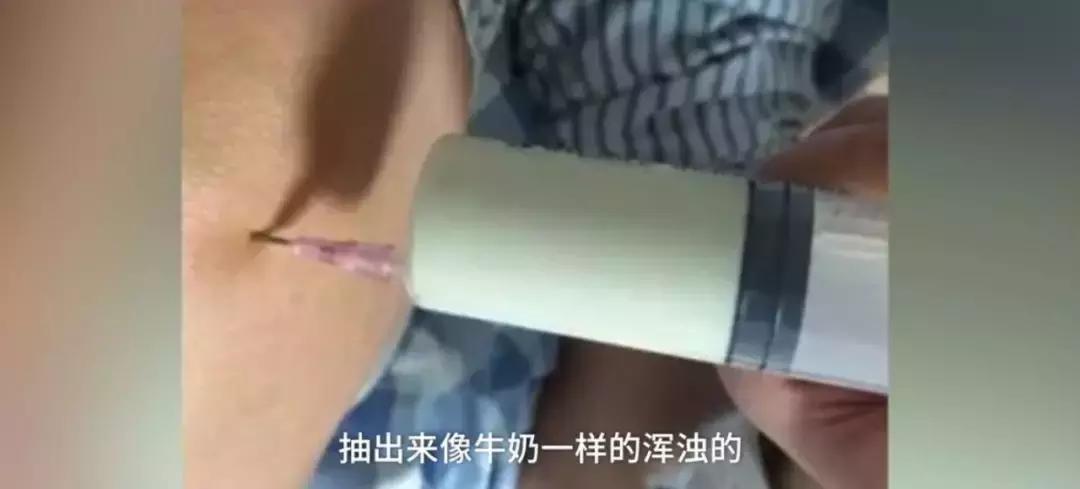 29岁男子患痛风：每天喝啤酒，膝盖抽出大量浑浊液体