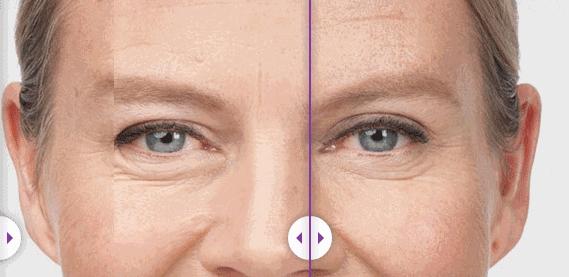 眼纹干纹是什么原因,眼部衰老导致眼纹