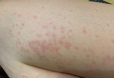 麻疹有哪些症状荨麻疹是啥样的,麻疹和荨麻疹的区别在哪里