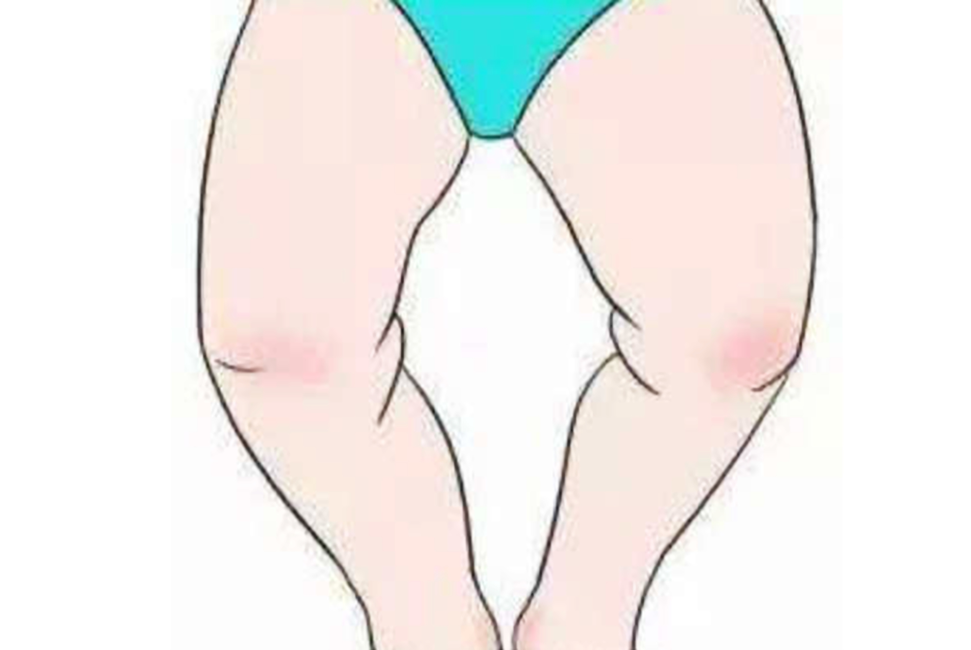 什么原因会导致孩子罗圈腿,孩子有点罗圈腿怎么矫正