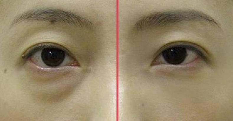 眼袋和卧蚕的区别教你区分小妙招,卧蚕和眼袋傻傻分不清的说说