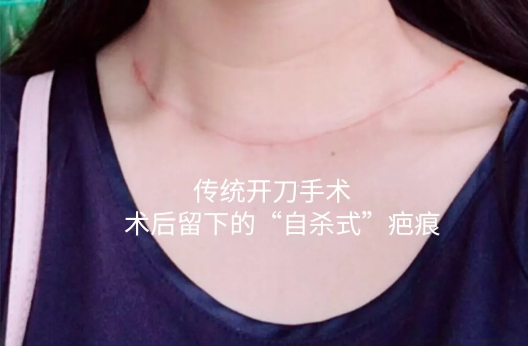 20多岁甲状腺结节,20岁得了甲状腺结节