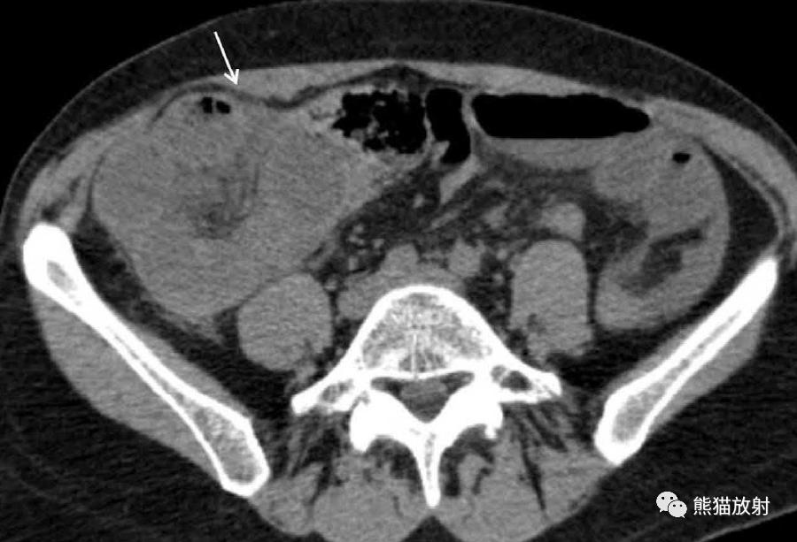 肠系膜解剖图,肠系膜解剖图解