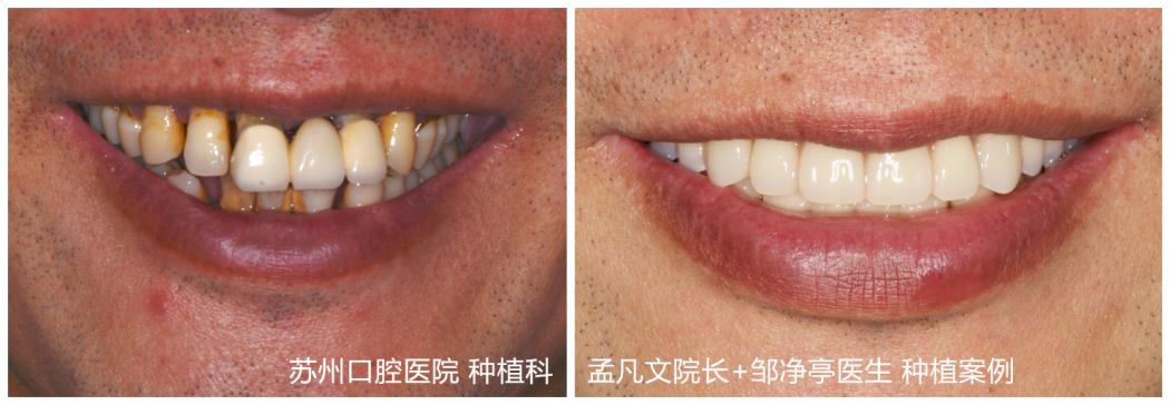 50岁种植牙,50岁了种植牙一颗多少钱