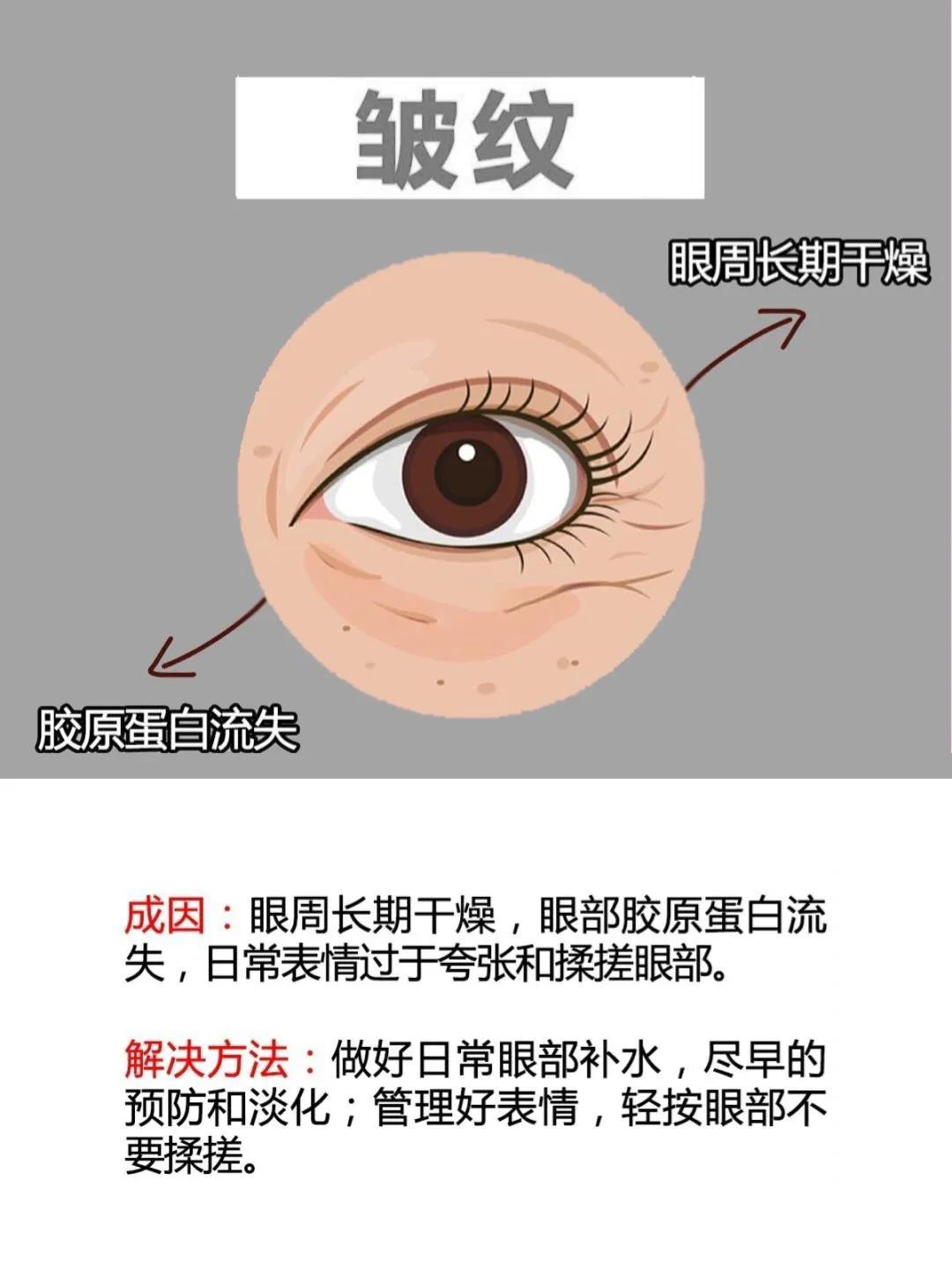 黑眼圈脂肪粒和细纹,一招解决眼袋黑眼圈眼角纹